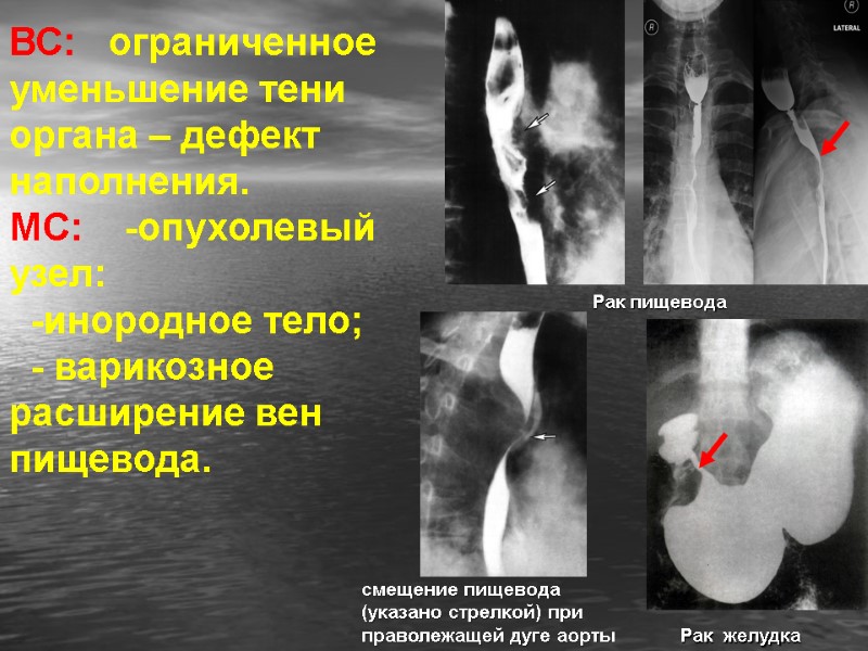 ВС:   ограниченное уменьшение тени органа – дефект  наполнения. МС:  